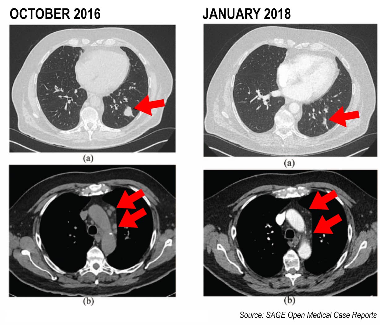Louis brain scan comparision